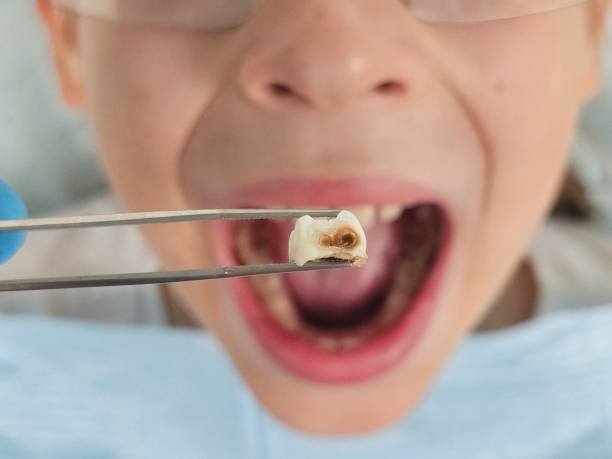 Best Urgent Care for Lost Fillings or Crowns in Centerport, NY