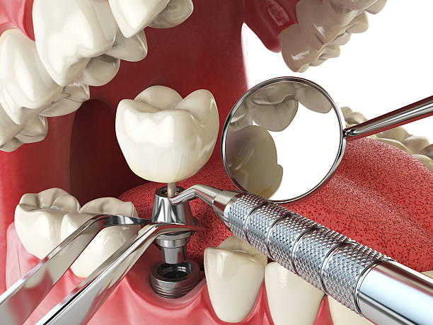 Best Emergency Wisdom Teeth Removal in Centerport, NY
